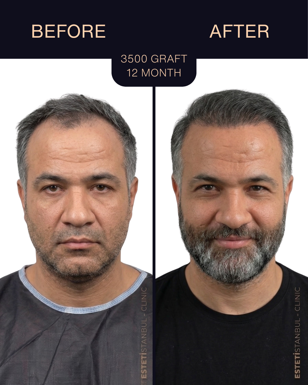 Hair transplant result - 3500 grafts