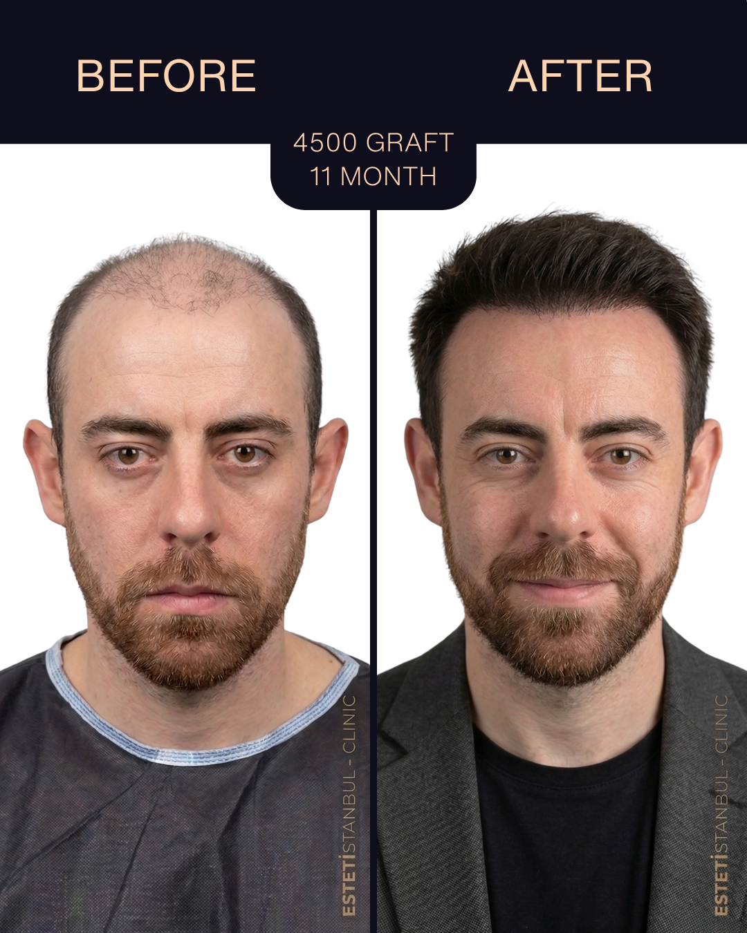 Hair transplant result - 4500 grafts