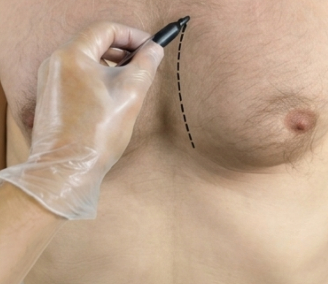 Jinekomasti (Erkekte Göğüs Küçültme)