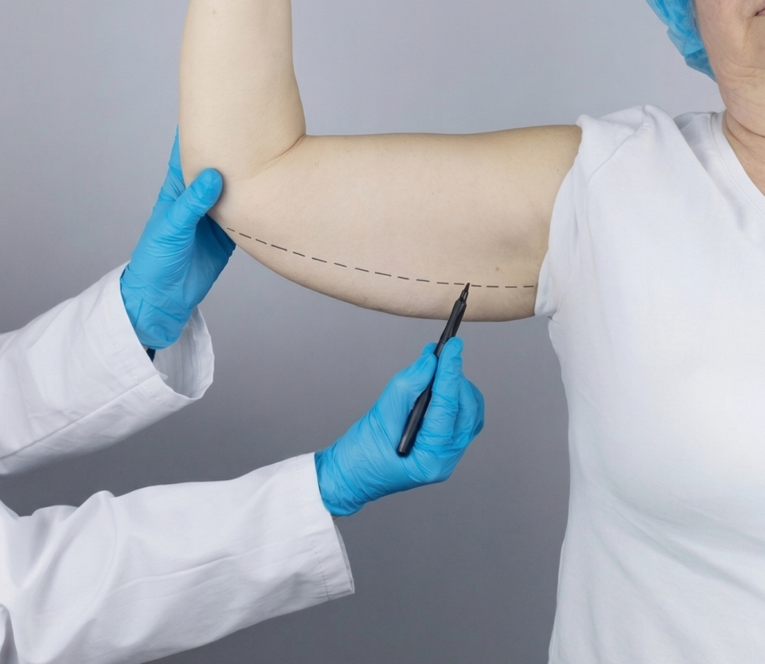 Kol Germe (Brachioplasti)