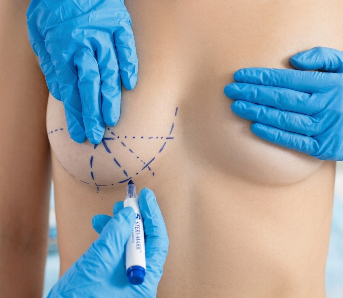 Göğüs Estetiği - Meme Büyütme